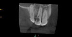 (9.) CBCT imaging of coronal section.