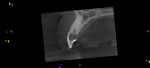 (10.) CBCT imaging of sagittal section illustrates the para-pulpal apical spread of the ICRR resorptive tissues, leaving a thin radiopaque band of dentin along the pulp canal wall.