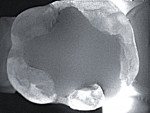 (6.) Mesial lingual cusp fracture detected on tooth No. 19, utilizing DEXIS CariVu.