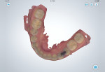 (10.) Digital impression displayed on an iPad to educate patient.