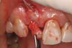 (8.) A connective tissue graft harvested from the
palate was used to help create a natural root prominence.
