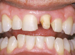 Figure 3  Minimally invasive preparations of teeth Nos. 7, 8, and 10 and the crown preparation of tooth No. 9.