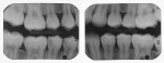 (1.) Immediately after removal of her orthodontic appliances this teenager had multiple decalcification and caries lesions.