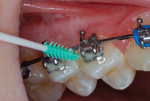 (5.) Interproximal insertion of the fluoride varnish under the arch wire.
