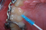 (7.) Lingual (palatal) insertion of the coated dental pick.