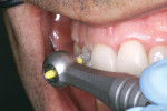 Figure 12  Gingival interproximal finishing with a reciprocating handpiece (Profinet) and flat, bladed Lamineer safe-sided diamond tips.