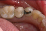 Figure 1. View of a failing amalgam restoration with recurrent decay present.