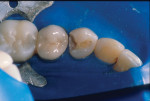 Figure 2. Following alloy removal, only infected dentin was carefully excavated for minimal intervention.