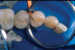 Figure 3. An anatomic matrix was properly
placed to seal the proximal aspect of the
tooth preparation.