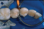 Figure 5. Using a simplified technique of composite resin placement, the buccal aspect of the tooth preparation was sculpted to its full
anatomical contour.