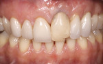 Fig 1. Patient presentation showing provisional crown on maxillary left central incisor with associated gingival recession after multiple surgical interventions to remove and replace a failing implant tooth No. 9.