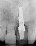 Fig 3. Periapical radiograph showed the replaced integrated implant with diminished root length of the adjacent teeth after years of orthodontic
therapy.