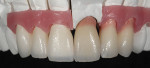 Fig 8. The build-up and layering of ceramics on the metal-ceramic coping, tooth, and gingiva-shaded veneers could be constructed simultaneously.