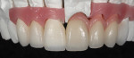 Fig 9. The final layering and build-up of the veneers and crown restoration.