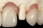 Fig 10. The beveled split-joint technique was used to segregate the pink veneers to give them separation of form. The flat contact area surfaces (Fig 11) were on an off-axis plane known as a beveled, or miter, joint.