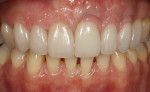 Fig 16. The intraoral esthetic integration of the tooth-colored veneers, metal-ceramic crown with gingiva-shaded porcelain, and the pink veneers is evident.