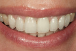 Fig 17. The patient’s smile, post-treatment.