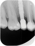 Fig 1. Radiograph of a HEAD type abutment. Note the presence of bone encircling the implant–abutment interface after 1 year of loading.