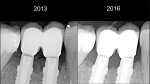 Fig 7. HEAD style abutment after 3 years of loading. Note that the first bone-to-implant contact has moved in a coronal direction over time.