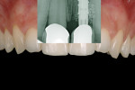 Fig 10. Radiograph of final result with cemented HEAD abutment. Note the excellent bone appearance.