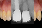 Fig 13. Radiograph of final result with screwed HEAD abutment. Note the excellent bone appearance.
