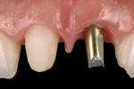Fig 8. Cemented HEAD abutment.