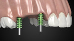 Fig 16. 3.8-mm transfers are fixed onto the abutments and retained through the transfer screw.