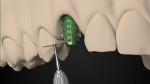 Fig 18. The analog of the abutment is accurately reduced with the aid of the PMMA template.