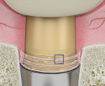 Fig 4. Connective tissue fibers encircling the base of the HEAD style abutment.