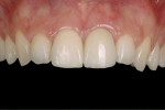 Fig 9. Final result with cemented HEAD abutment.