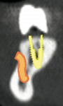 Figure 6a  Virtual treatment plan image <strong>(A)</strong> for placement of implant No. 21. Comparewith CT scan of actual implant placement <strong>(B)</strong>. Note the close proximity of the plannedimplant and the actual implant placement to ass