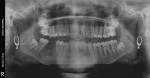 Fig 3. The diagnosis of maxillary bilateral paramolars was confirmed by an OPG radiograph.
