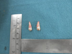 Fig 4. The extracted bilateral paramolars were dysmorphic, conical, and single-rooted with three poorly developed cusps.