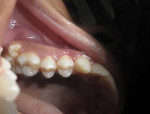 Fig 1. Left maxillary paramolar in association with first and second left maxillary permanent molars, preoperative.