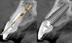 Fig 2. Osteotomy needs to be corrected so it does not follow the trajectory of the extraction socket but instead should be tipped palatally so that implant placement yields a thicker facial socket wall, which is easier to maintain and preserve long term.