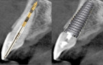 Fig 1. When implant osteotomy follows the trajectory of the extraction socket in the maxillary anterior, implant placement compromises the facial wall of the socket, which may lead to fenestration or potential loss of the implant over time when loaded.