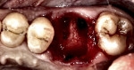Fig 9. Extraction of the maxillary molar typically presents with bone in the furcation area and voids where the roots were present (illustration).