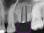 Fig 11. When an emergence profile is created at the missing molar site on a 4-mm-wide implant, food traps are introduced below the proximal contacts, making oral hygiene a challenge for the patient.