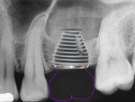 Fig 15. When width of the ridge and mesial–distal spacing will allow, a 9-mm-wide implant will more closely approximate the molar that was extracted, providing the optimal emergence profile, with less chance of proximal food traps.