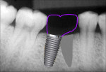 Fig 16. When the implant is placed into the distal root space, a mesial cantilever results, with an ensuing food-trap area proximally and off-axis loading of the implant.