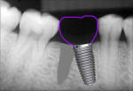 Fig 17. Similarly, when the implant is placed into the mesial root space, a distal cantilever results, with an ensuing food-trap area proximally and off-axis loading of the implant.