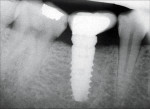 Fig 18. A cantilever crown results when the implant is not centered in the edentulous space, creating food traps interproximally.