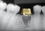 Fig 21. When an abutment that matches the width of the implant is used, it may limit the prosthetic result, creating an abnormally sized restoration when a wide implant has been placed.