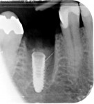 Fig 7. The implant has been placed into the furcation area of the immediate extraction socket (Smith-Tarnow type B), shown before socket grafting to fill voids present that housed the roots.