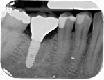Fig 8. After 4 months of healing of the socket grafting and implant integration, the implant has been restored. Note that the outline of the previous socket walls can be identified, demonstrating osseous encasement of the implant.