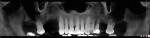 Fig 4. CBCT rendition of resorbed maxillary arch.