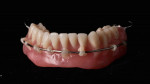 Fig 11. Mandibular immediate partial denture.