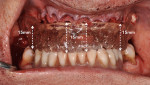 Fig 9. Maxillary reduction guide indicating amount of reduction needed.