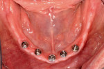 Fig 17. Completed mandibular arch immediately after initial removal of conversion prosthesis.