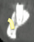 Figure 6b  Virtual treatment plan image <strong>(A)</strong> for placement of implant No. 21. Comparewith CT scan of actual implant placement <strong>(B)</strong>. Note the close proximity of the plannedimplant and the actual implant placement to ass
